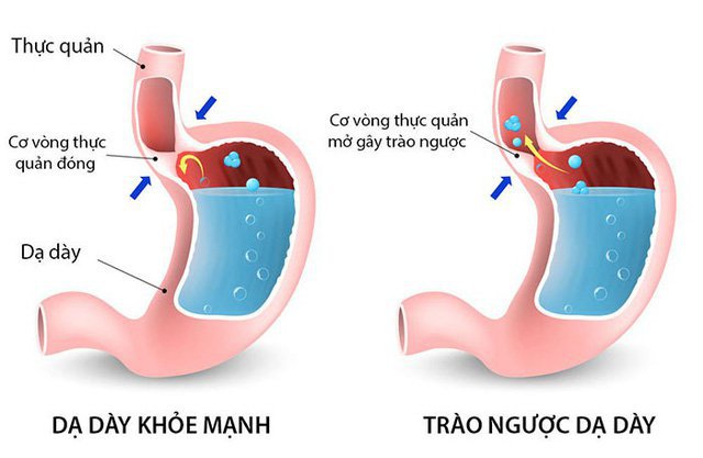 Trào ngược dạ dày thực quản: Nên ăn gì và kiêng ăn gì?