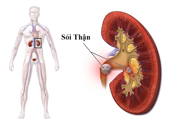 TỔNG QUAN VỀ SỎI THẬN