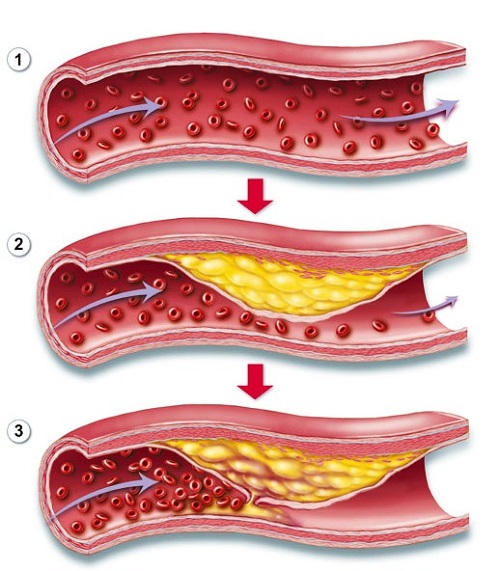Rối loạn mỡ máu: Nguyên nhân, triệu chứng và cách điều trị