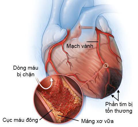 Mỡ máu bao nhiêu là bình thường, bao nhiêu là cao?