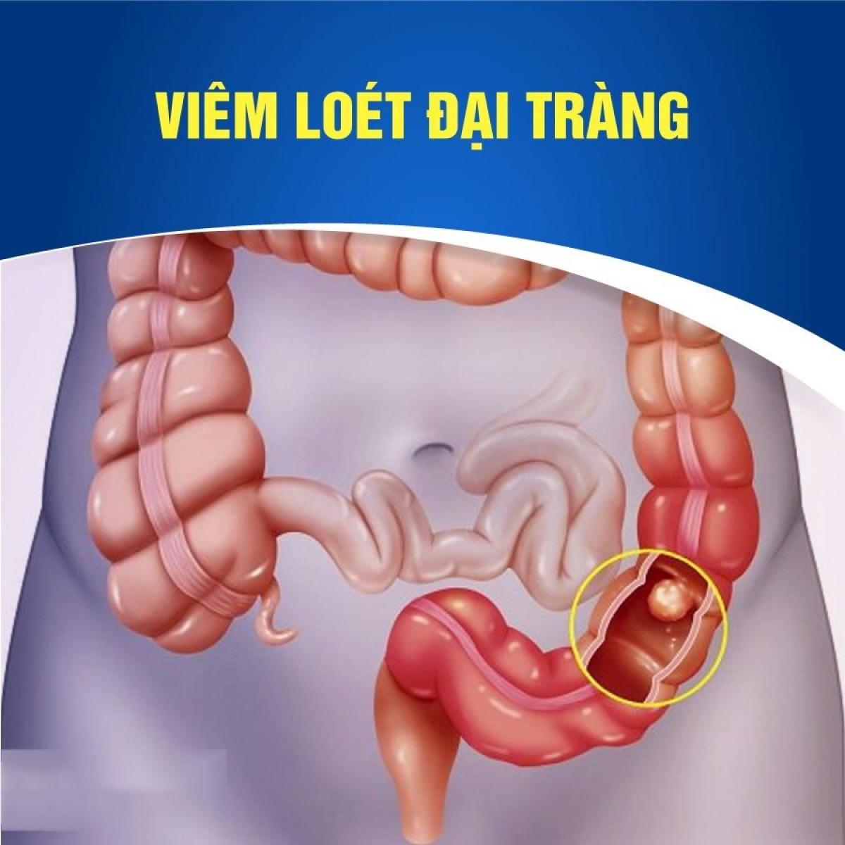 Đại tràng bị “tàn phá” bởi bia rượu – Bảo vệ bằng cách nào?