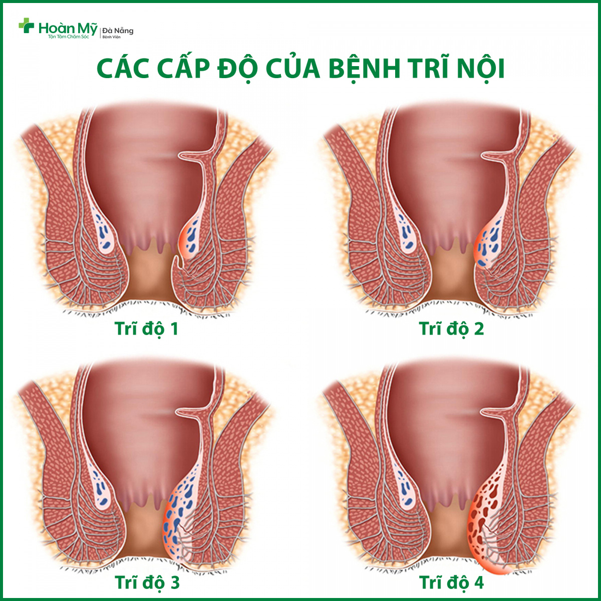 PHÂN LOẠI BỆNH TRĨ VÀ CÁC PHƯƠNG PHÁP ĐIỀU TRỊ HIỆU QUẢ HIỆN NAY