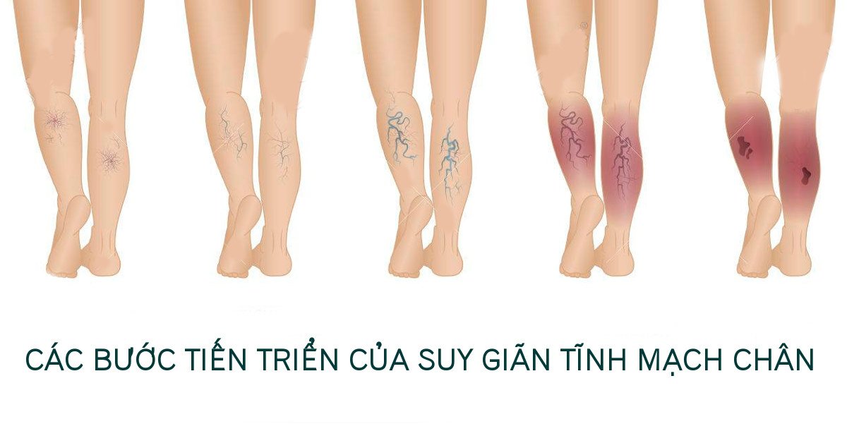 NGUYÊN NHÂN VÀ TRIỆU CHỨNG GIÃN TĨNH MẠCH CHÂN